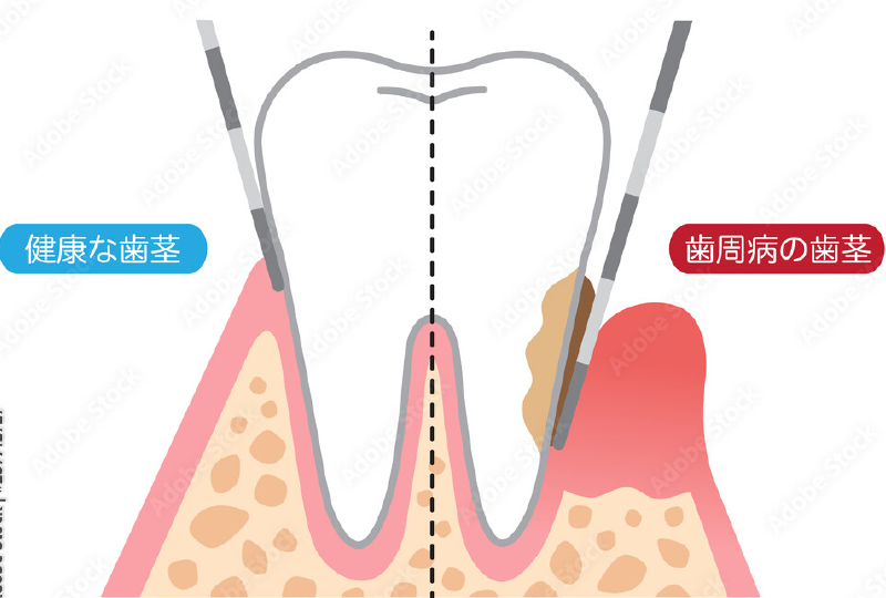 歯周病の治療内容