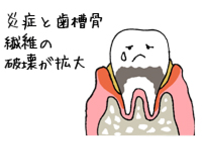 第三段階：中度歯周炎