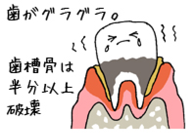 第四段階：重度歯周炎