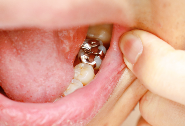 銀歯で本当に良いのか？を十分にお考えください
